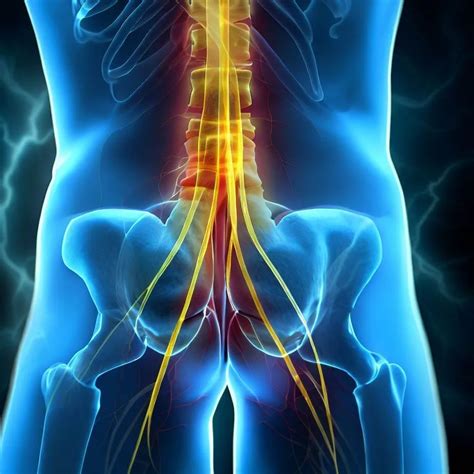 poze cu nervul sciatic|Nervul sciatic (sciatica): cauze si tratament